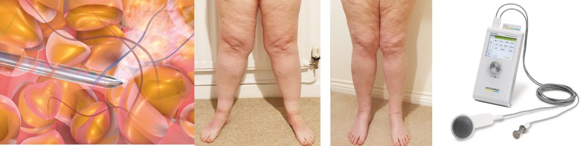 image shows a before and after picture of lipoedema liposuction legs, the deep oscillation unit and fat being extracted by a canula in liposuction procedure